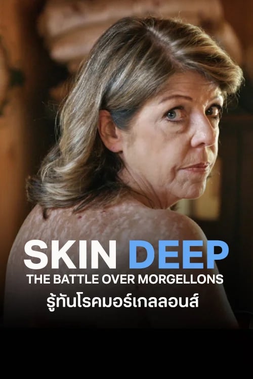 รู้ทันโรคมอร์เกลลอนส์